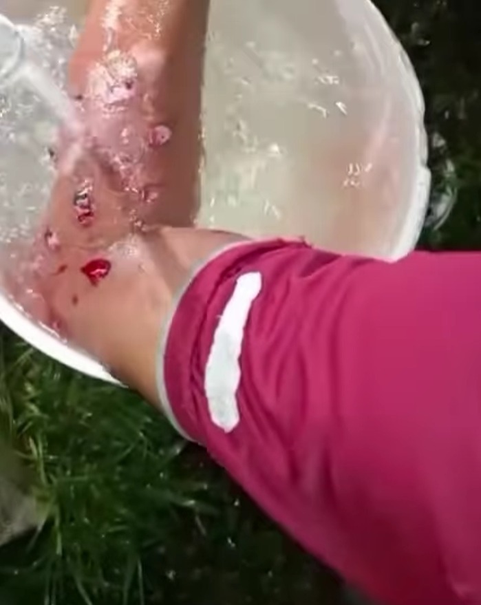 Injury buckshot